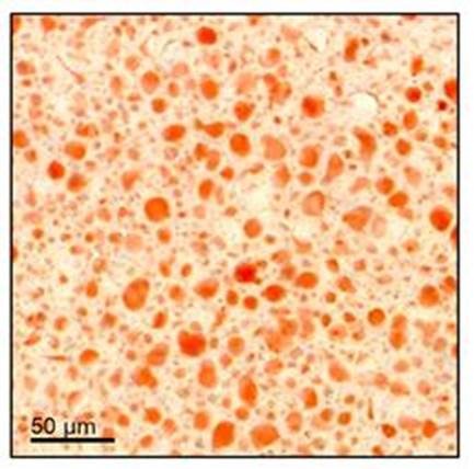 Fat accumulation in the liver